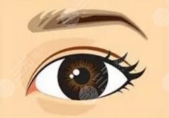 覃方燕手术案例:网友做双眼皮2个月后恢复自然！