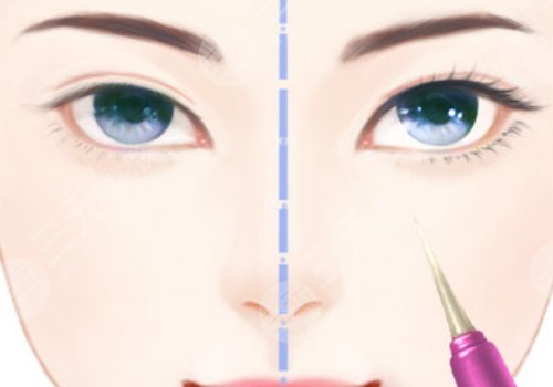 苏州邓哲双眼皮