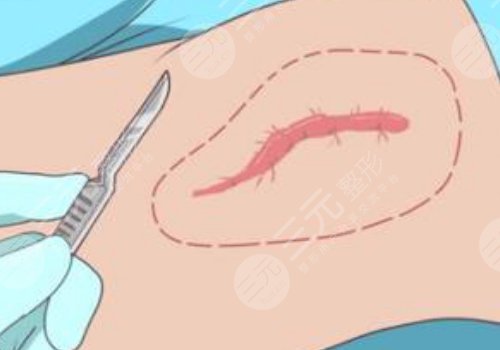 汕头莱美医疗美容门诊部祛疤怎么样