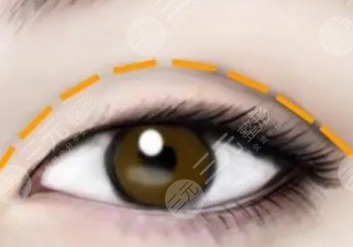 武汉郭亮医生做双眼皮手术多少钱