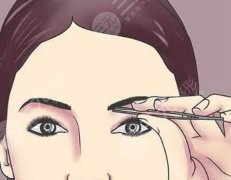 打眉弓有什么好处?术后护理方式一览 打眉弓有什么好处?术后护理方式一览