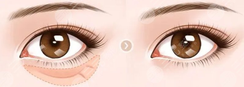 刘波眼袋祛除案例