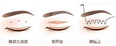 马志兵医生做双眼皮如何？案例反馈，江苏省中医院热门之选！