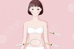 吸脂后多久可以再次吸脂?科普分享,想瘦身别心急! 吸脂后多久可以再次吸脂?科普分享,想瘦身别心急!