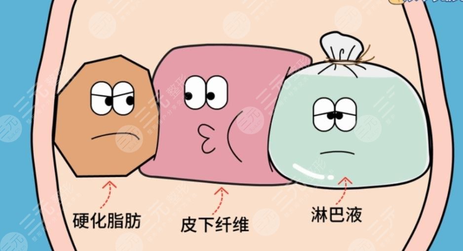 吸脂