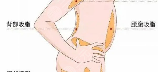 360度环形吸脂腹部