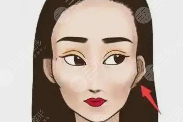 颧骨突出矫正