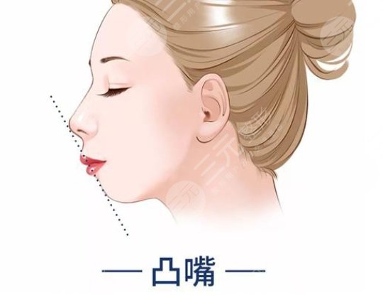 凸嘴正颌