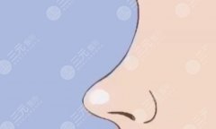 肋骨隆鼻可以维持一辈子吗？想做软骨垫鼻子，这篇科普别错过！