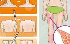 大腿吸脂后怎么快速消除腿部水肿?术后恢复指南,一篇汇总! 大腿吸脂后怎么快速消除腿部水肿?术后恢复指南,一篇汇总!