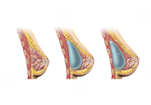 假体胸是什么材料做的