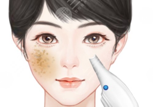 汕头市中心医院祛斑价格