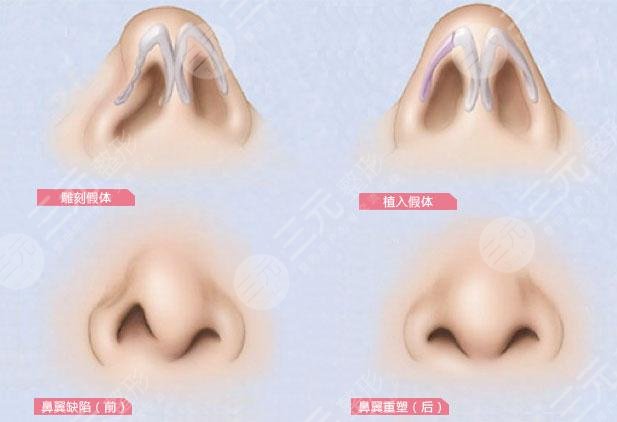 隆鼻尖太尖可以修复吗?整形失败别急,重塑美鼻我帮你!