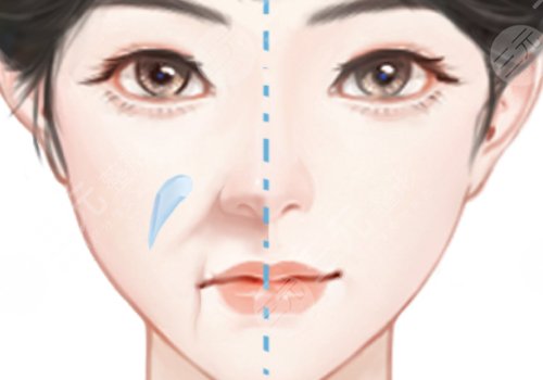 鼻部整形修复
