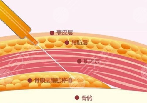 整容下巴多少钱