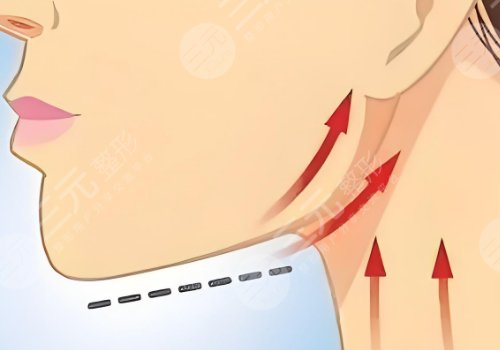 下颚线整形多少钱