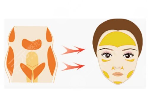 脂肪填充全脸怎么样