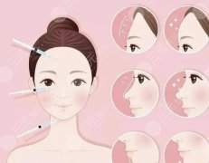 脸部松垮做什么医美项目好?4种方案分享,重塑紧致面容! 脸部松垮做什么医美项目好?4种方案分享,重塑紧致面容!