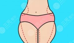 抽脂肪对身体有没有伤害？吸脂瘦身科普，手术原理来了解一下！