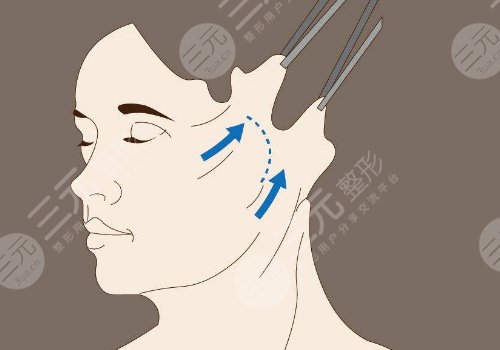 双眼皮下垂怎么解决