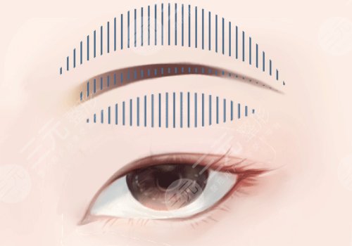 双眼皮下垂怎么解决