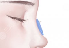 膨体假体隆鼻优缺点在线一览，美鼻术前必看