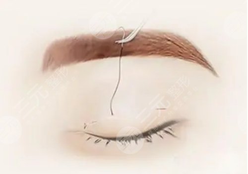 三眼皮迅速恢复双眼皮