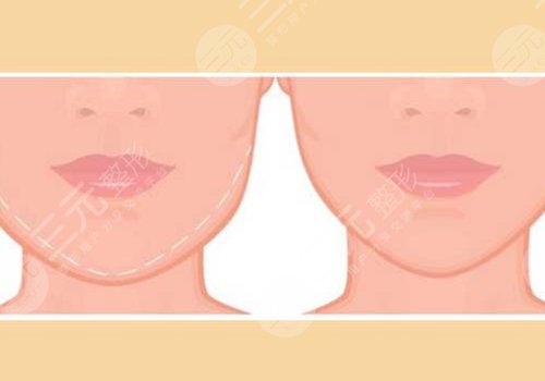 下颌骨歪了怎么矫正