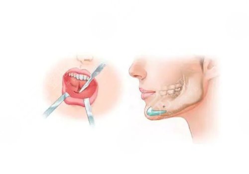 下颌骨歪了怎么矫正
