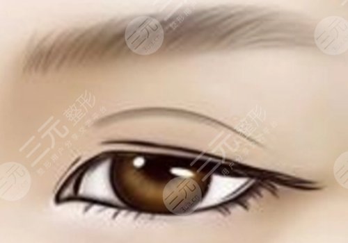 双眼皮修复是不是重新做一次