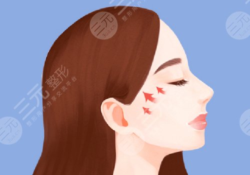 颧骨手术费用一般多少