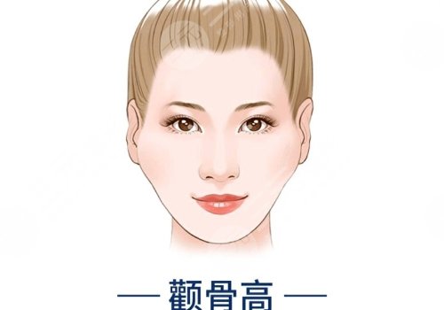 颧骨手术费用一般多少