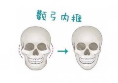 颧骨手术费用一般多少?价格大概4万元-8万元不等! 颧骨手术费用一般多少?价格大概4万元-8万元不等!