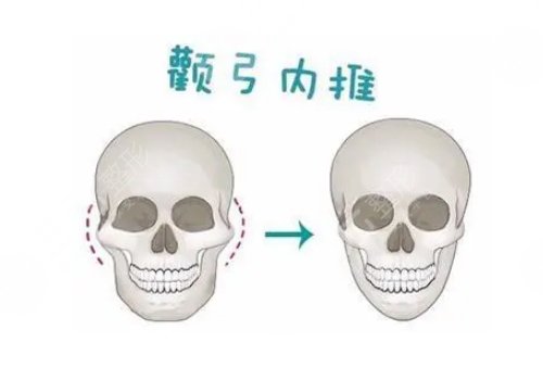 颧骨手术费用一般多少