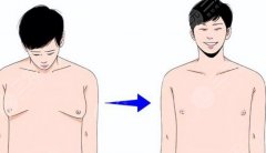 男生怎么减胸部肥肉？男士缩胸指南，吸脂帮你搞定它！