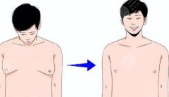 男生怎么减胸部肥肉?男士缩胸指南,吸脂帮你搞定它! 男生怎么减胸部肥肉?男士缩胸指南,吸脂帮你搞定它!