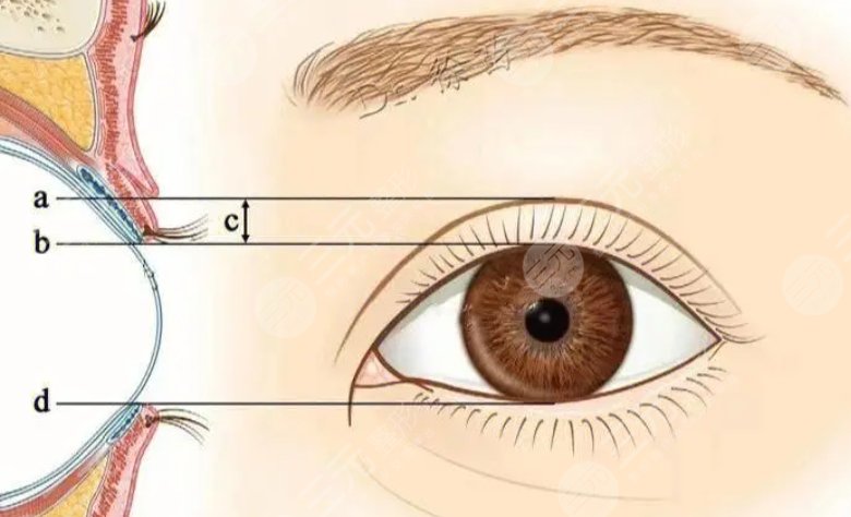 单侧双眼皮提肌