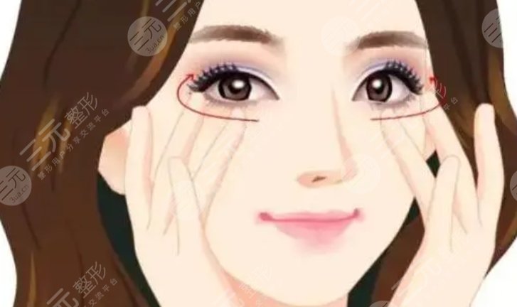 单侧双眼皮提肌