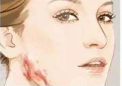 增生疤痕疙瘩怎么能彻底消除？祛疤修复指南，费用参考！