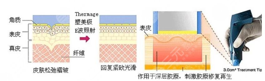 热玛吉