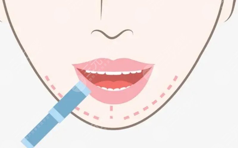 嘴唇整形