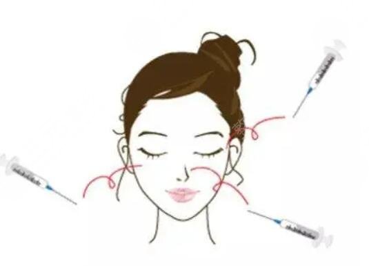 玻尿酸注射