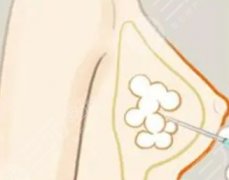 脂肪填胸多久定型？自体丰胸手术科普，这些你要知道！