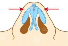 垫鼻梁用硅胶好还是膨体好？假体隆鼻材料这样挑选！