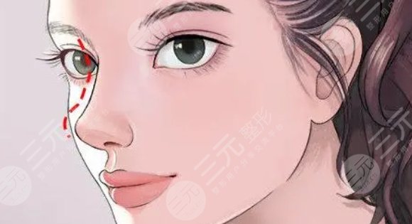 隆鼻
