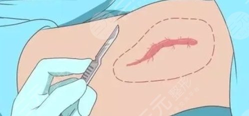 疤痕大腿