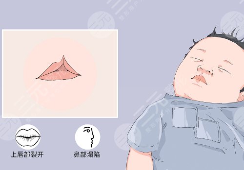 谢思田唇裂修复