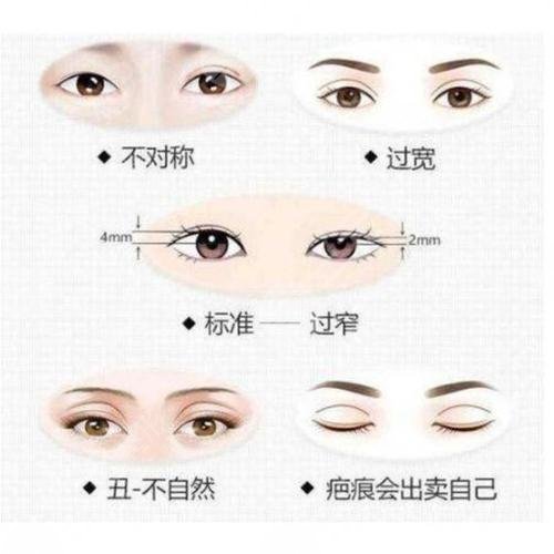 福州林振辉医生双眼皮修复案例分享