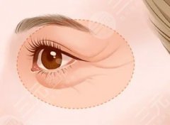 眼下干纹做什么医美好？2种不同方案，帮你解决眼周老化问题！