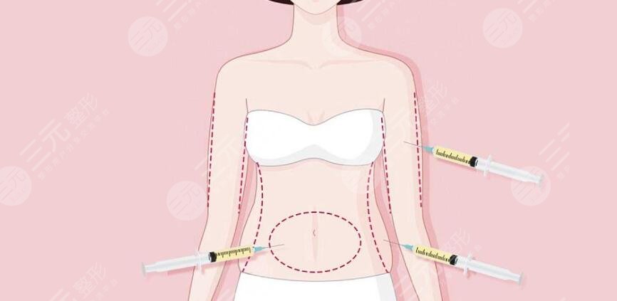 腰腹吸脂